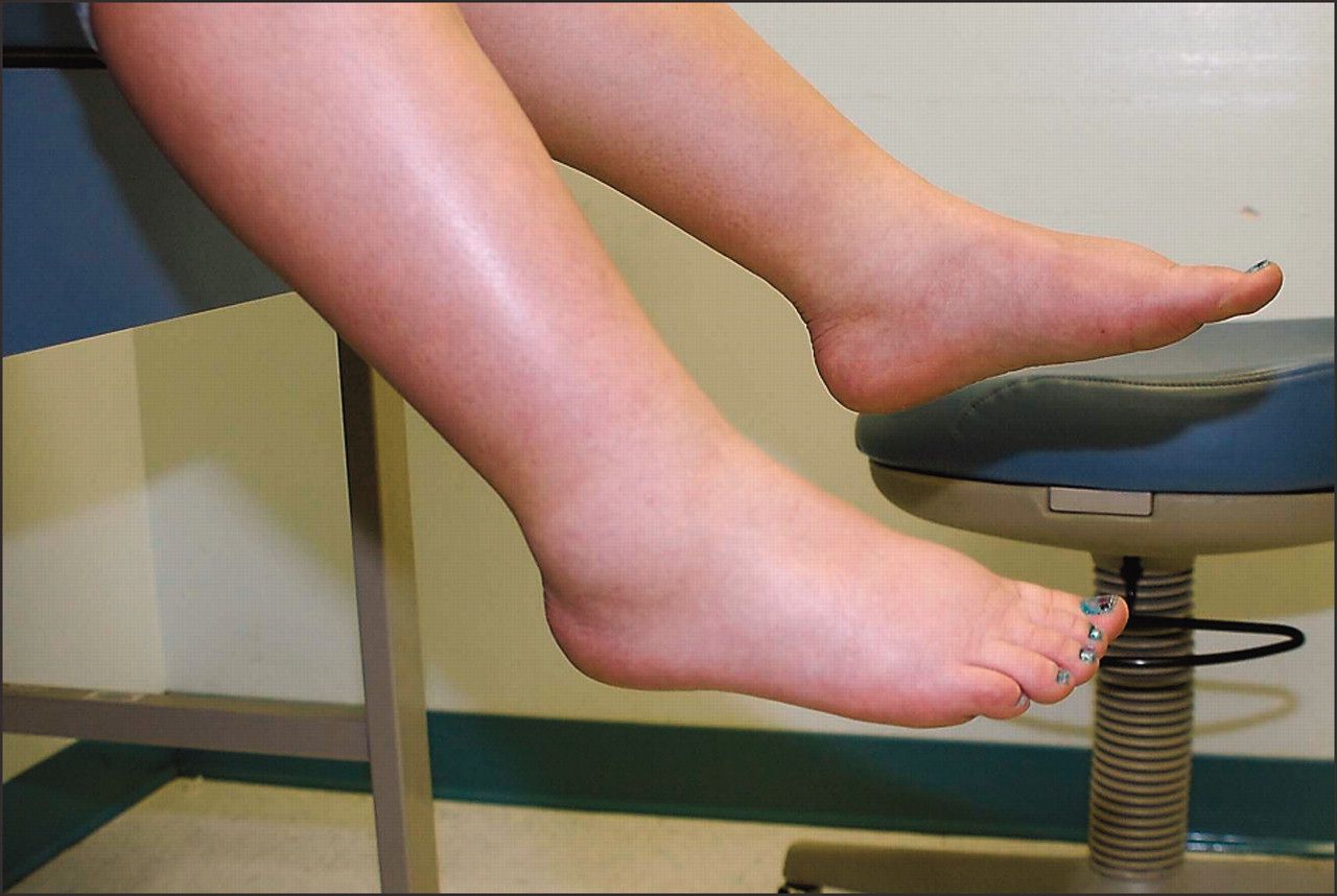 Swelling of feet during pregnancy - Causes and Treatment